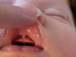 Infant Screening for Lip Tie in South San FranciscoPicture