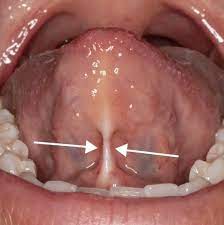 Comprehensive Screening for Tongue & Lip Ties in Teens & Adults