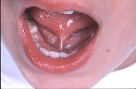 Children Screening for Tongue Tie in South San Francisco