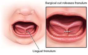 Newborn/Infant Screening Tips for Tongue & Lip Ties - South SFPicture